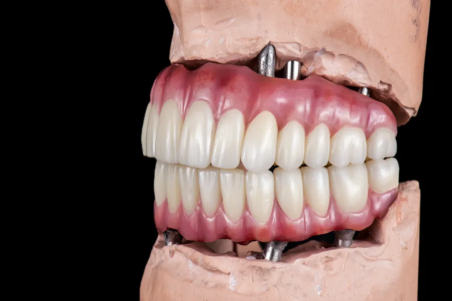 A model of a person's teeth with a denture