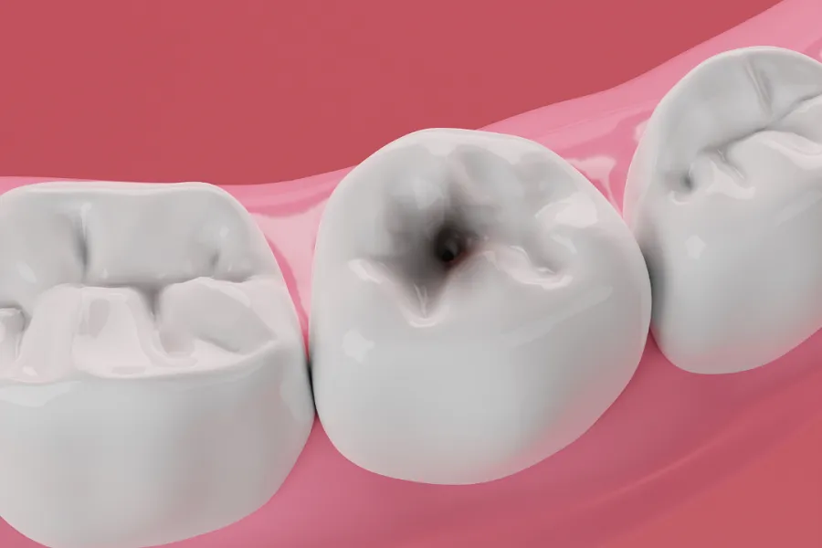 Close-up of a dental cavity in a molar tooth on a pink background